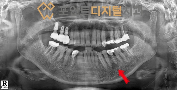  [탕정치과]  iGBR(급속골이식) + PDRN(연어주사) + 디지털 가이드 + 비절개 임플란트 / 천안 아산