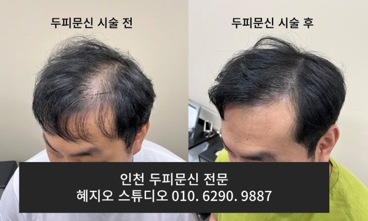  원형탈모 감쪽같이 커버하는 인천 송도 두피페인팅 리얼후기