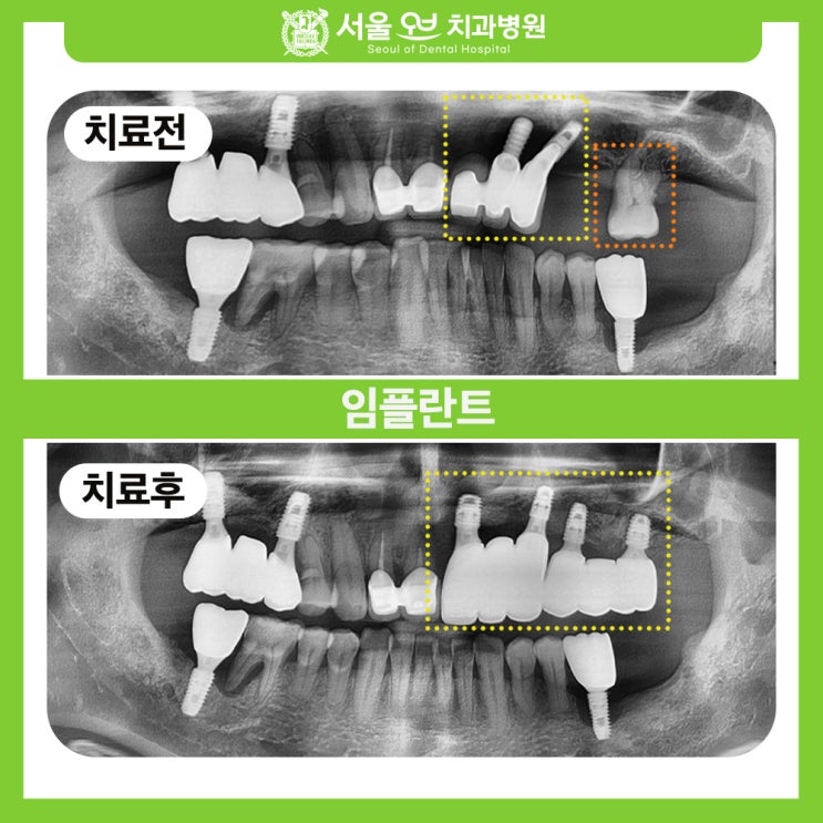  [삼전역치과잘하는곳] 잇몸까지 재현한 맞춤 보철, 더 이상 감추지 않아도 되는 미소
