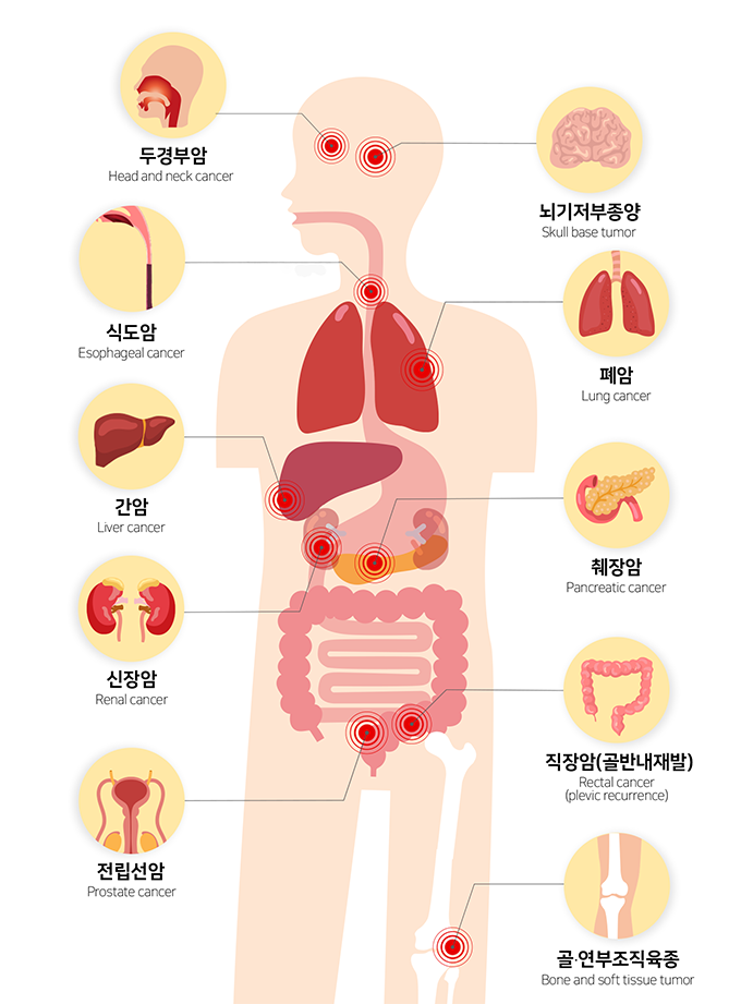  [연세대 중입자 암치료 정보] 국내 최초 차세대 암치료센터 소개