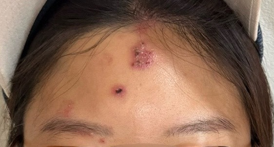20대 여자 얼굴 대상포진 전조증상 및 후유증 후기 - 두통, 안면마비, 귀 통증 (골든타임 희망....