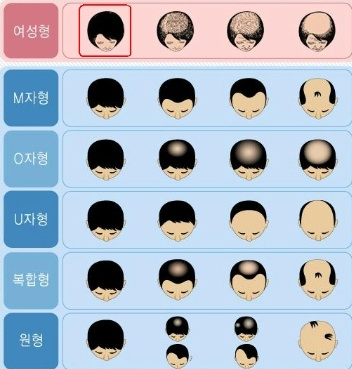  정수리 탈모 원인부터 예방법까지 총정리!