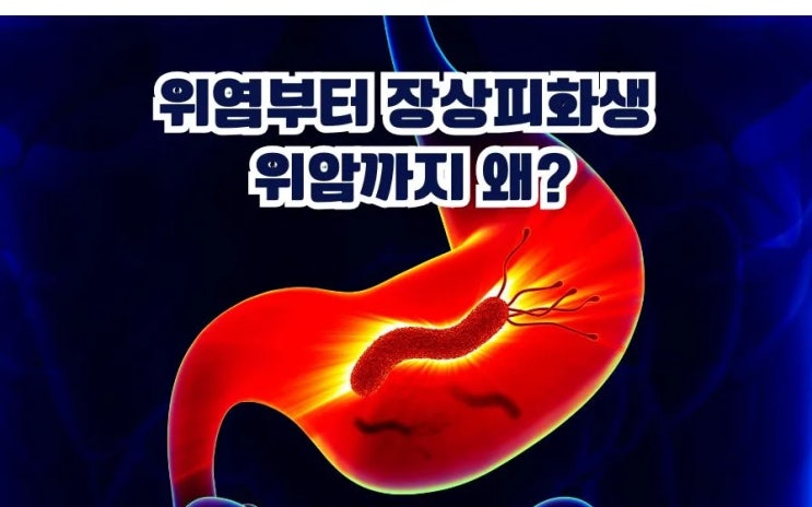  위염 장상피화생 위암까지 진행 왜? 위염에 좋은 음식