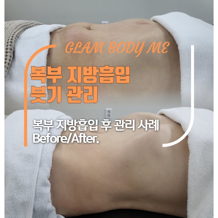  복부 지방흡입 붓기, 얼마나 오래가고 어떻게 관리해야 할까요? (2주 차 - 5주 차) B&A