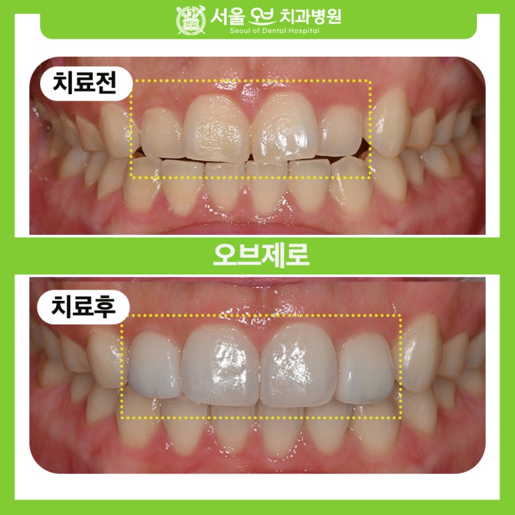  [삼전역치과추천] 토끼이빨처럼 튀던 앞니, 단 4개의 라미네이트로 자연스럽게!