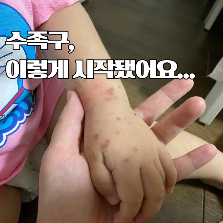 수족구 초기 증상 이렇게 나타났어요