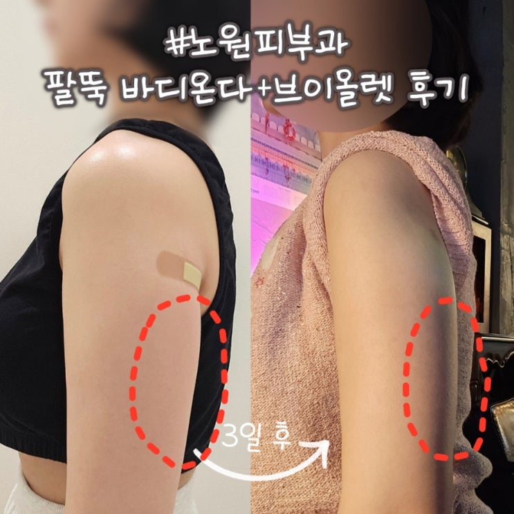  노원 피부과에서 팔뚝살 정리해 봤어요 (바디온다, 지방분해주사)