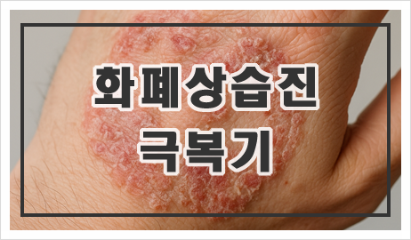 화폐상습진 어떻게 치료하나? 치료 방법과 과정