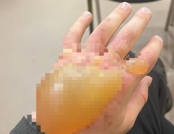 "예쁘다고 만졌다간 큰일 나"⋯日서 발견된 이 독초 정체는?