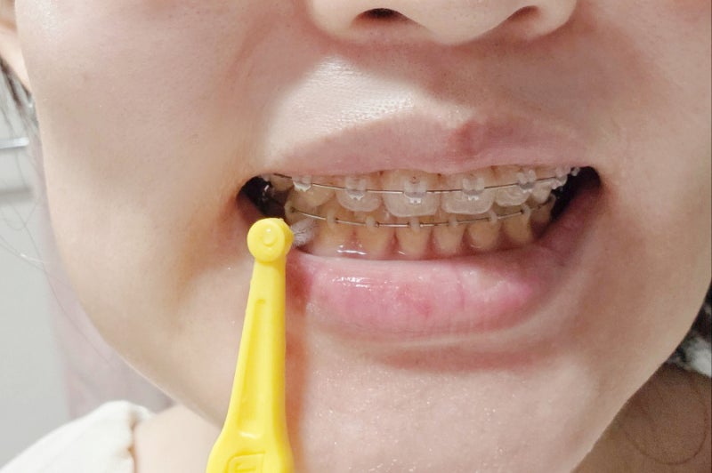 테페치간칫솔L형 후기- 교정인 추천 어금니치간칫솔