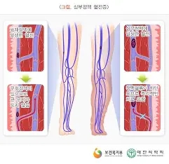심부정맥혈전증(DVT) 예방