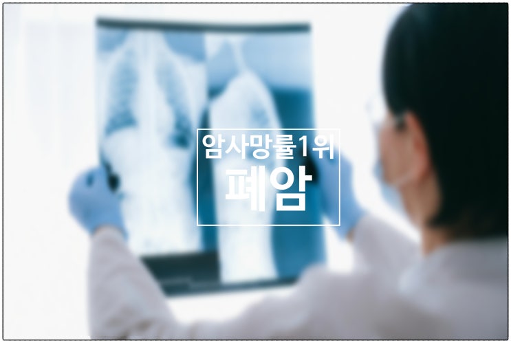  국내 암 사망률 1위 폐암....."조기 발견하려면 이것 중요"