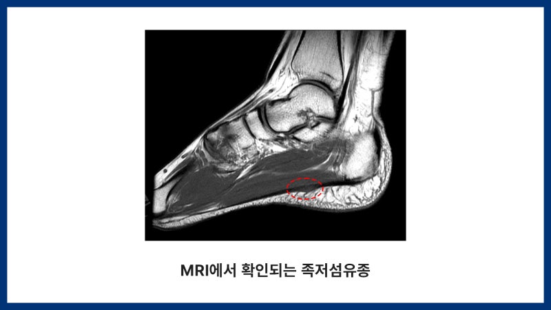 발바닥 통증, 족저근막염? 족저섬유종 수술 사례