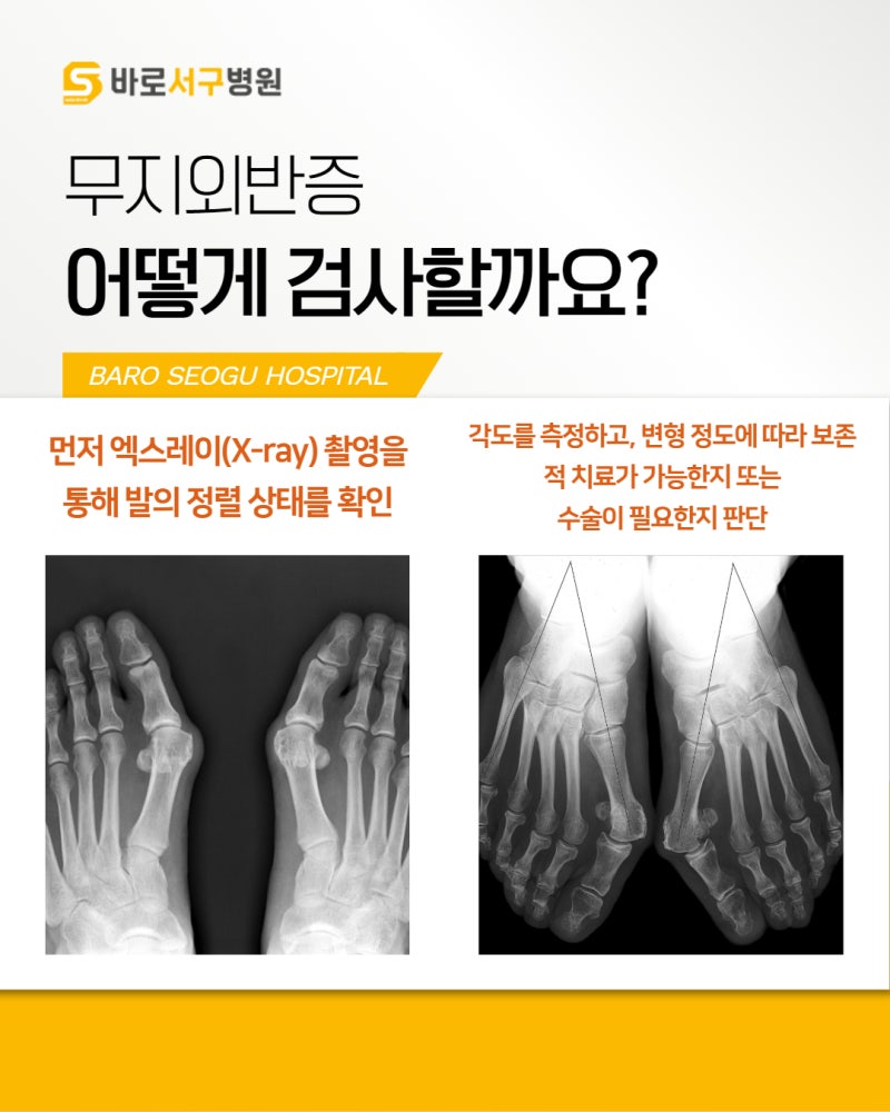 인천 무지외반증병원 수술 후 바로 걸을 수 있는 방법 MITA