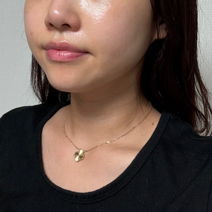  맑은 얼굴을 위해 받은 포토나레이저 색소레이저 후기