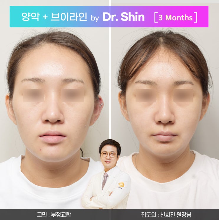   신희진 원장님_부정교합 양악수술비용과 후 회복기, 운동으로 더 빠른 회복 꿀팁 