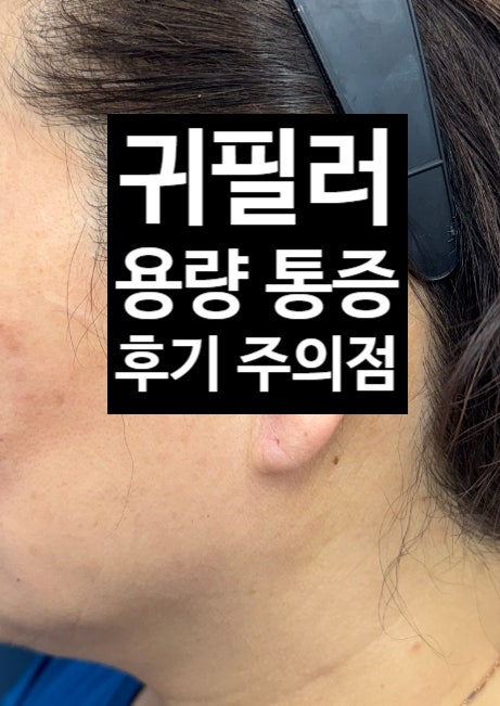  귀필러후기 용량 가격 통증 부작용 아르네의원