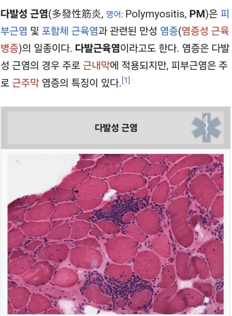 염증성 근육병증에 속하며 몸통 가까운 쪽 근육의 근력저하 증상이 나타나는(다발성근염 및 ....