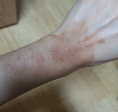  얼굴이 간지러워요 증상 리도맥스 연고 사용해도 될까?