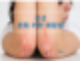 건선 피부, 어떻게 관리하면 좋아질까?