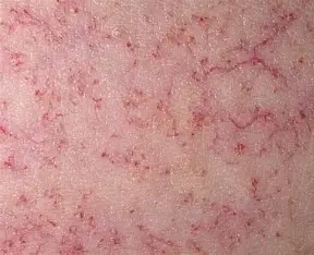 특발성 모세혈관 확장증 Telangiectasias