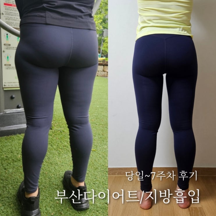 부산다이어트 결심하고 지방흡입 받았어요 7주차 후기 꿀팁