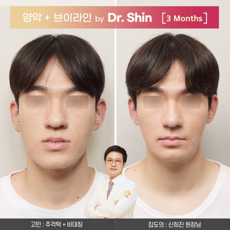   신희진 원장님_주걱턱 + 비대칭 양악수술 후 운동으로 얻은 변화, 수술 후 내 모습은 이렇게 