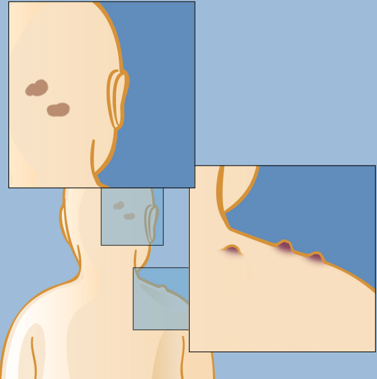 우리 아기 갑자기 생긴 작은 혹이나 반점 혹시 신경섬유종 ? 원인 증상 검사 치료 정보