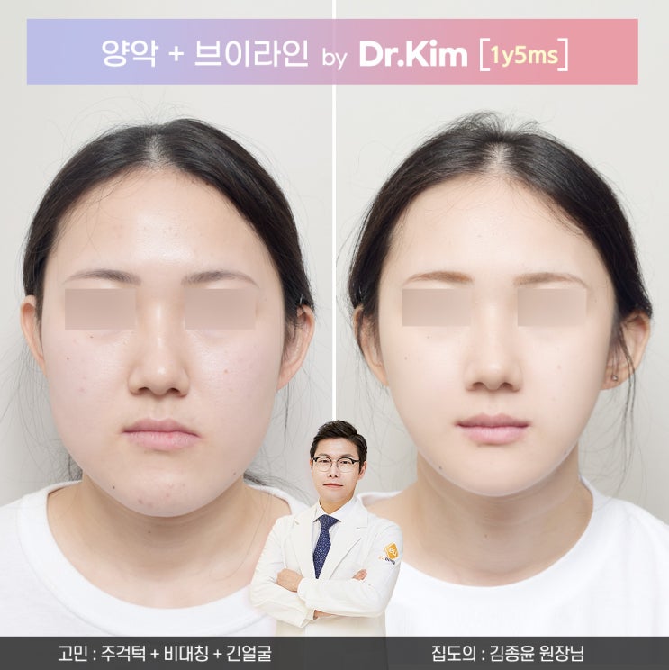   김종윤 원장님_양악수술 잘하는 곳에서 주걱턱 비대칭 긴얼굴 교정! 수술 과정과 비용 