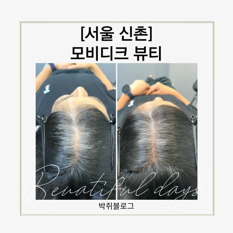  신촌smp 후기엄마 정수리 두피문신 1회차 기록