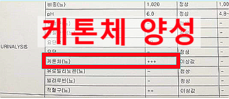 소변검사 케톤체 양성 반응 의미 증상 원인 관리법