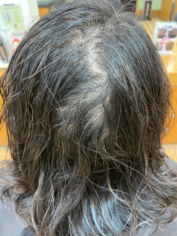  경상북도에서왔다구요? 여성탈모로인한정수리사이드탈모 볼륨이너무없어요 풍성하게 해드리겠습니다