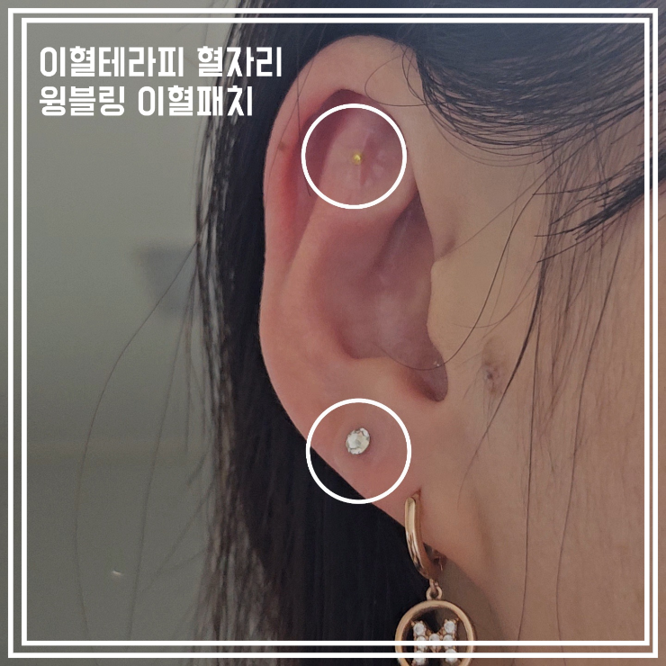  이혈테라피 혈자리 효과 윙블링 이혈패치로 예쁘게!