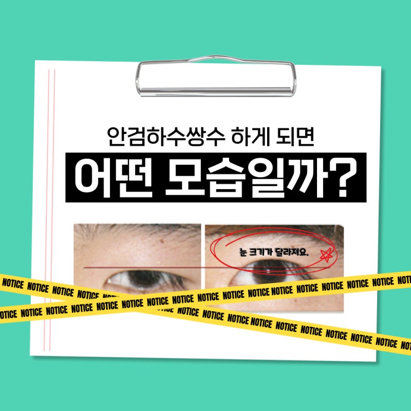 안검하수쌍수 달라지고 바뀌는 곳 표시해봐요
