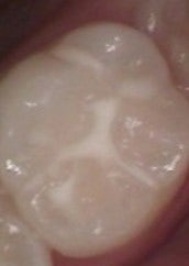   만 18세 이하 보험 적용! 아프지 않은 실란트 치료로 치아 건강 지키기!