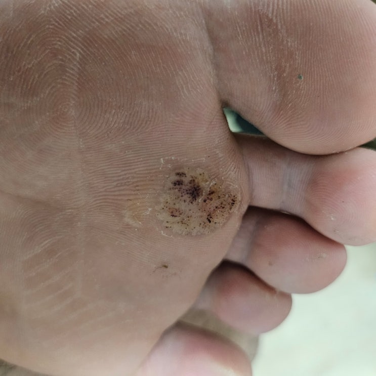  사마귀 치료 중, 셀프 정리 해봤어요… 내일 냉동치료 갑니다!