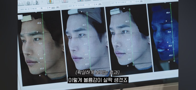 육준서 중안부 리프팅 4회차 진짜 중안부 줄어들었나? 전후 비교