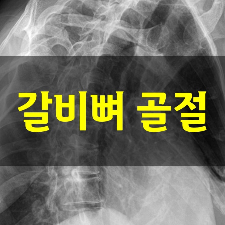  갈비뼈 골절 진단과 회복기간 필요 영양소