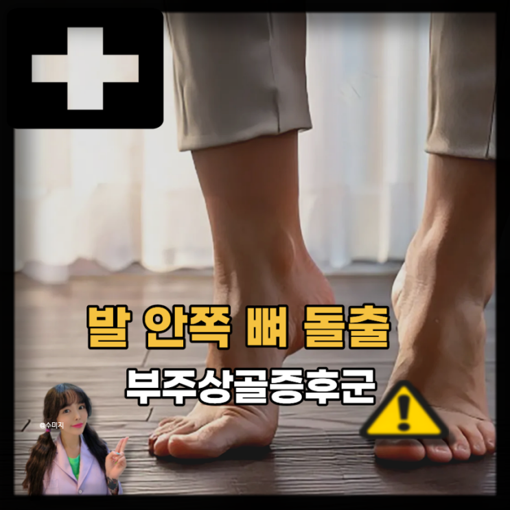  부주상골 통증 부주상골증후군 증상 수술