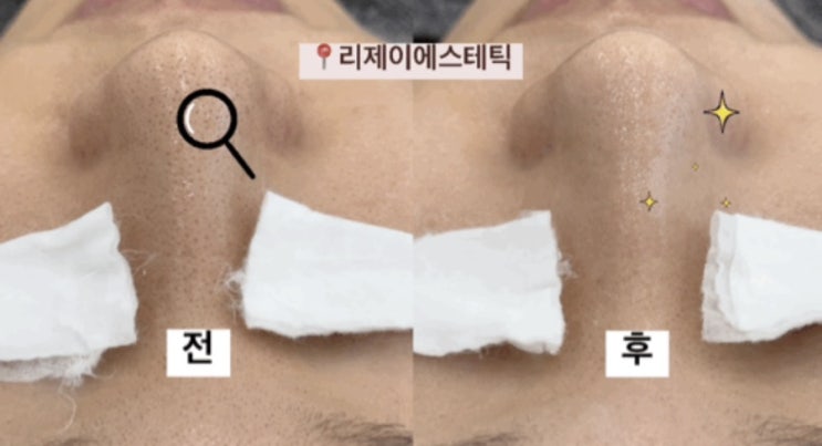  리제이에스테틱 부산모공관리 효과 미친 세멘시트 관리 후기