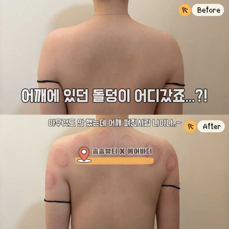  승모근아 잘가~천안 솜솜뷰티 에너지테라피 리얼 체험기