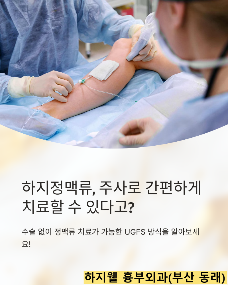 하지정맥류 주사치료, 카테터를 이용한 초음파 유도하 거품 혈관 경화요법