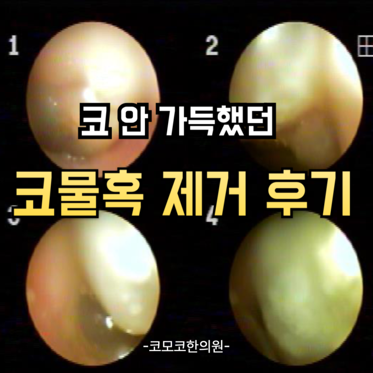  코물혹 한의원 후기 (feat. 코모코한의원 코물혹 비수술)