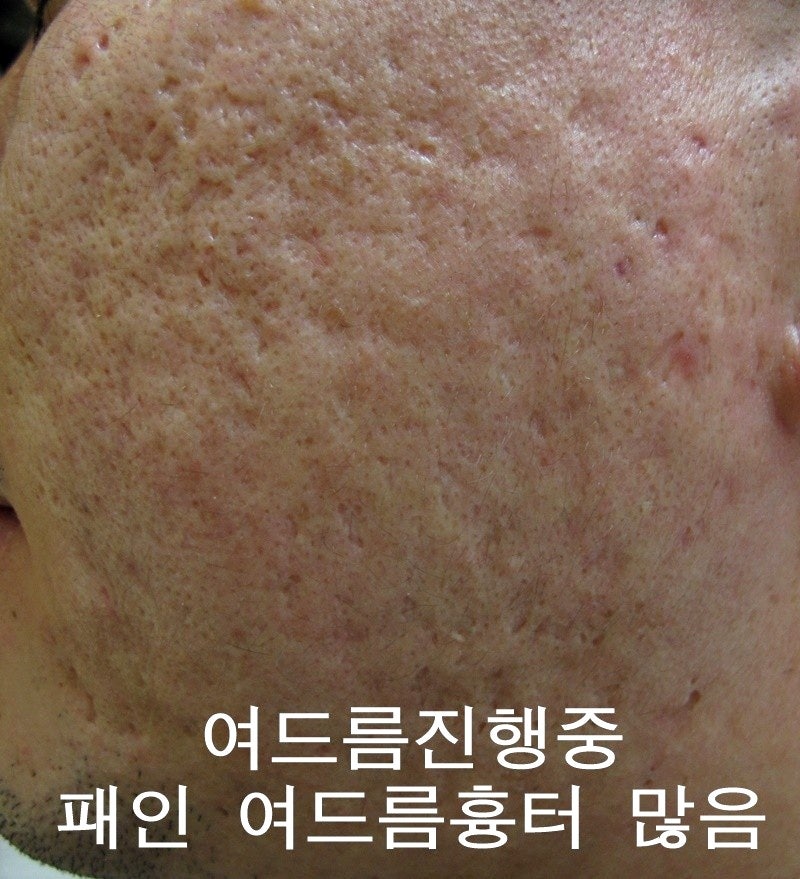 여드름흉터 레이저 가격 효과 내돈내산 후기