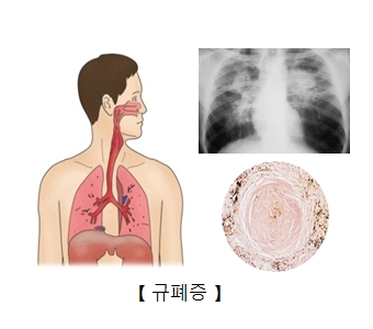 규폐증(silicosis)