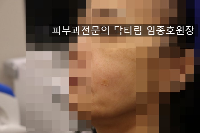 리투오 눈밑, 볼륨증가용으로도 - 피부과전문의 닥터림