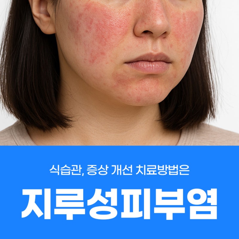 지루성피부염 식습관, 증상 개선 치료방법은