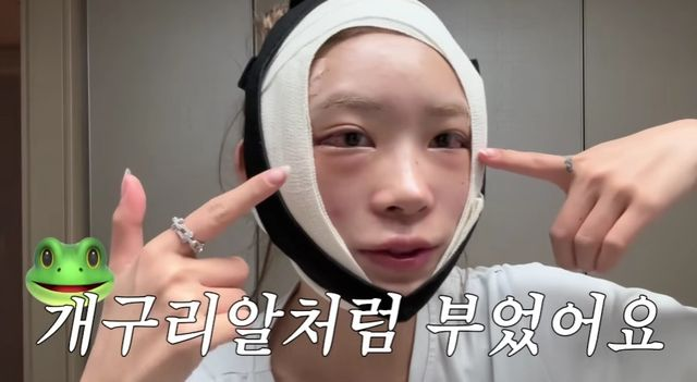 최준희, 윤곽 성형 후 '충격 비주얼'…"앞 안 보여"·"마취 세게" 생생 후기