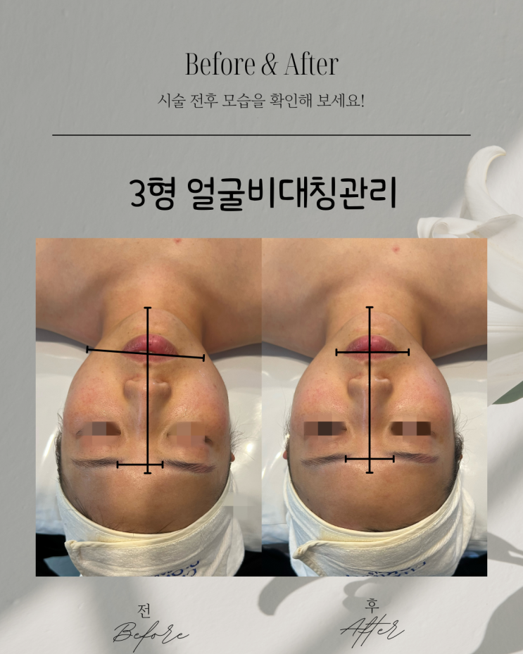  부산피부관리 - 얼굴비대칭 3형 일까