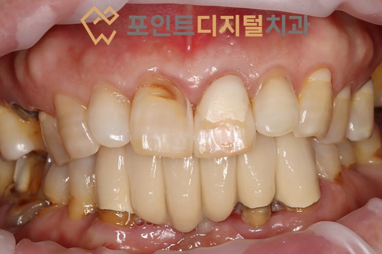  [탕정치과]  발치즉시 임플란트와 하이니스 디지털 보철을 이용한 임시치아 제작 / 천안 아산
